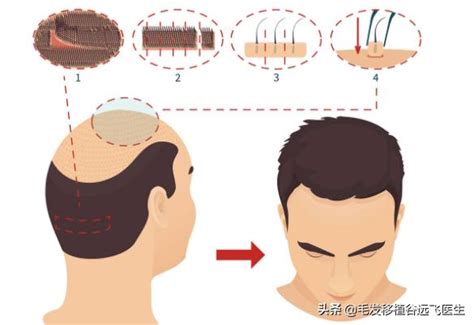 額頭長細毛